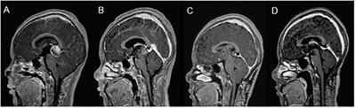 Intracranial non-germinomatous germ cell tumors in children and adolescents: how can the experience from an uppermiddle-income country contribute to the worldwide effort to improve outcomes?
